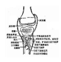 急性化膿性骨髓炎