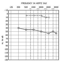 傳導性聽力損失的示意聽力圖