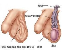 精索靜脈曲張