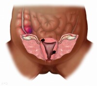 直腸粘膜脫垂的早期癥狀