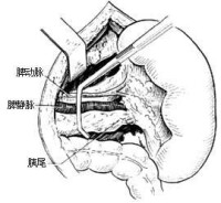 自身免疫性淋巴細胞增生綜合征