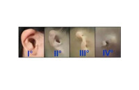 傳導性聽力損失