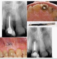 根管充填材料