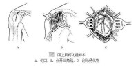 岡上肌鈣化搔刮術