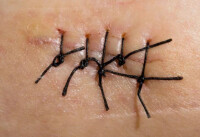 微創手術縫傷口