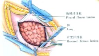 示意圖4:切除劍突