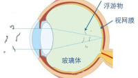 玻璃體液化