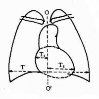 心胸比率=(T1+T2)/T