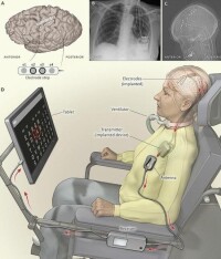 “腦機介面”技術應用於“法醫精神病鑒定”