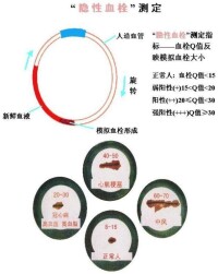 體外血栓測定結果