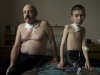 在白俄羅斯首都明斯克的一家醫院，兩名核事故受害者在接受治療，都是甲狀腺癌