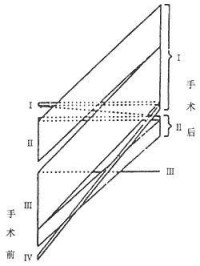 心包剝脫術