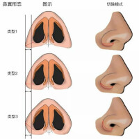 自創鼻翼上提術