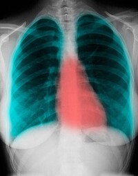 X線胸片