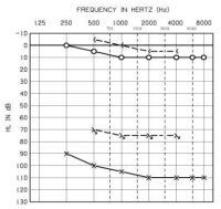 單側聾的示意聽力圖01