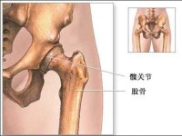 小兒股骨頭壞死