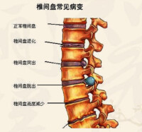 脊柱相關病