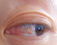 眼瞼裂斑