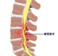 椎管狹窄