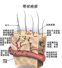 皰疹