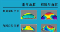 近視眼激光手術