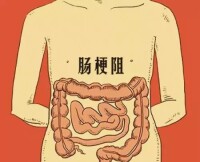 急性腸梗阻