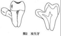 雙牙畸形