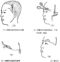 眉再造手術操作圖