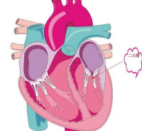 風濕性二尖瓣關閉不全