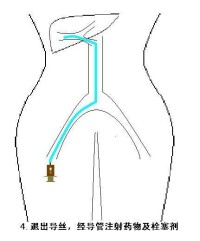 退出導絲，注射藥物及栓塞劑