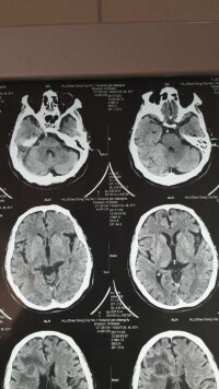 原發性腦瘤