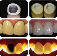 金屬烤瓷牙和全瓷牙對比