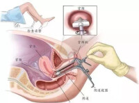 宮頸位於陰道深處