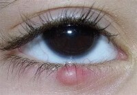 眼瞼裂斑
