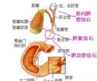 肝膽繫結石