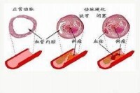 糖尿病腎臟病變