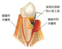 牙槽骨修整術