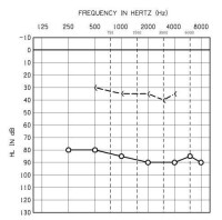 混合性聽力損失的示意聽力圖