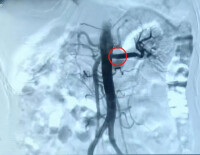 腎動脈支架