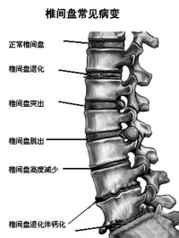 急性腰椎間盤突出