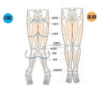 八字步後果&amp;quot;X型腿&amp;quot;