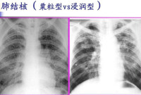 浸潤型肺結核