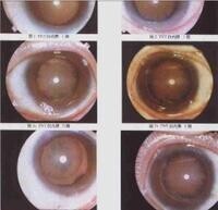 三硝基甲苯白內障
