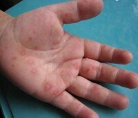 手足口病——腸道病毒71型感染性疾病知識