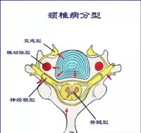 頸椎增生