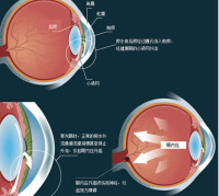 慢性青光眼