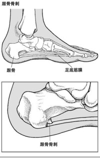 足跟骨刺