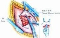 示意圖3:切除兩側畸形的全部肋軟骨