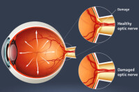 視神經損害