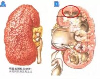 腎前性